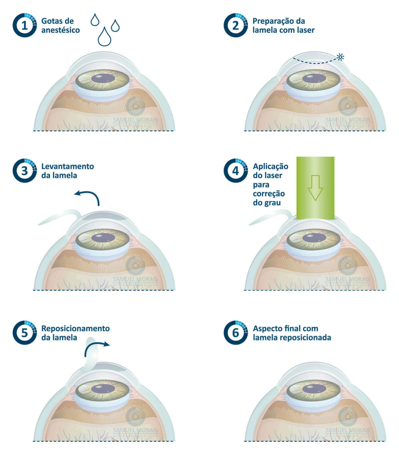 Cirurgia Refrativa